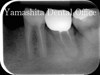 大阪市都島区の山下歯科。根管治療の手順について。